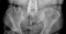 Achieving Success with Uncemented Hip Arthroplasty Metal Socket