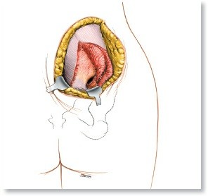 Illustration of posterior superior iliac - Dr. Mohammed Hutaif