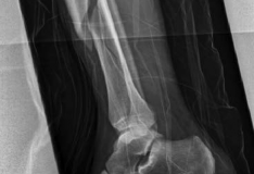 Illustration 19 for Tibial Fracture Extending into the Plafond: Intramedullary Secrets