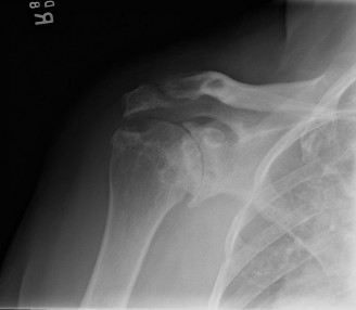 Glenohumeral Rheumatoid Arthritis: When to Suspect Septic Arthritis