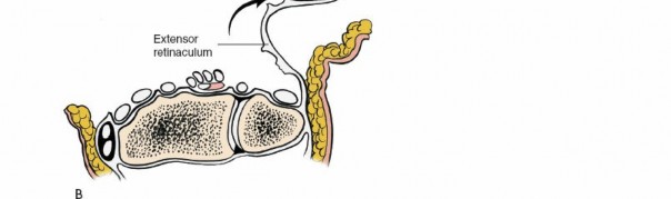 Illustration 13 for Dorsal Wrist Approach: Expert Access to the Column of the Distal Radius