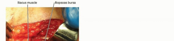 Illustration 18 for Septic Hip in Children: Mastering Anterior Drainage for Optimal Recovery