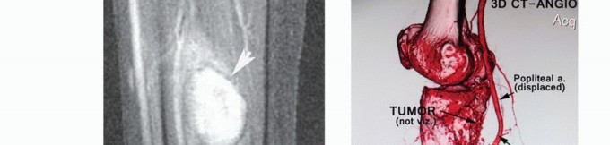 Illustration 3 for Soleus Resection for Tumors: Protecting the Heads of the Gastrocnemius