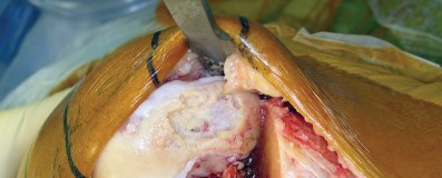 صورة طبية: استبدال مفصل الركبة بالحد الأدنى من التدخل الجراحي: ألم أقل وتعافٍ أسرع مع النهج شبه الرضفي الإنسي