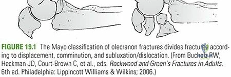 Illustration of olecranon fractures olecranon - Dr. Mohammed Hutaif