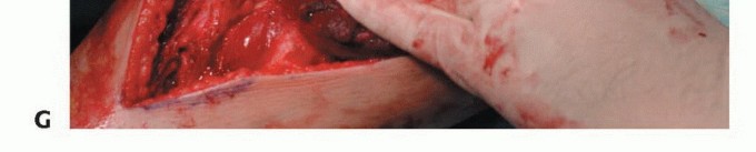 Illustration 38 for Beyond Amputation: The Type I Resection in Fibular Tumor Surgery