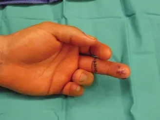 إصلاح الأوتار القابضة في اليد: دليل شامل للتعافي من إصابات اليد مع الأستاذ الدكتور محمد هطيف