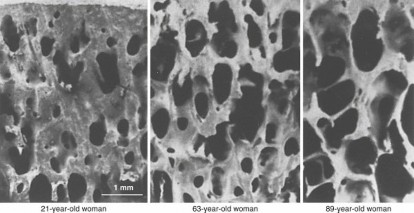 Illustration of bone mineral density - Dr. Mohammed Hutaif