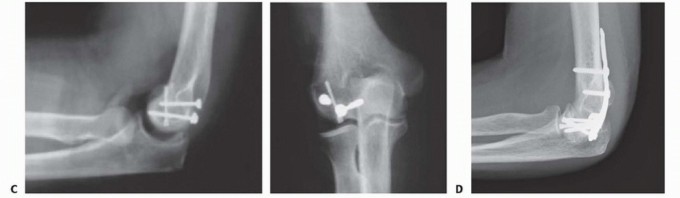 Illustration 9 for Navigating Capitellum and Capitellar-Trochlear Shear Fracture Repair