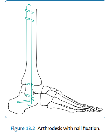 Illustration 2 for What to Expect: Ankle Surgery Postoperative Care & Instructions