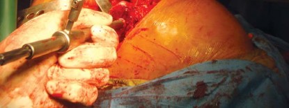 Illustration 33 for The Silent Hip: Achieving a Truly Silent, Pain-Free Joint