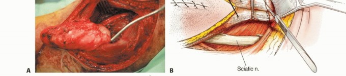 Illustration 16 for Posterior Thigh Resection: Rethinking Outcomes & Limb Sparing