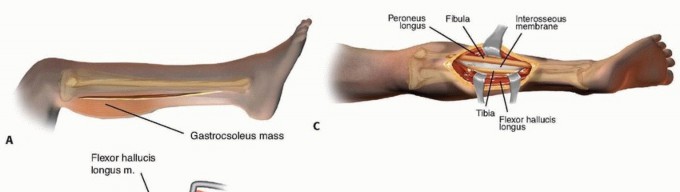 Illustration 20 for Acute Compartment Syndrome: Timely Fasciotomy Explained