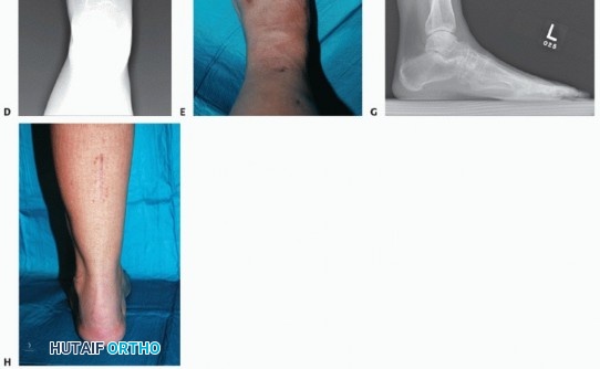 Illustration 69 for Mastering Midfoot Arthrodesis: Protect the Deep Neurovascular Bundle