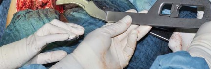 Illustration 44 for Collum Femoris Preserving: Achieve Better Primary Hip Outcomes