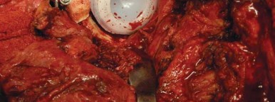 Illustration 53 for Navigating Early THA for Fractures of the Acetabulum