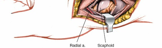 Illustration 197 for Essential Surgical Approaches: Uncover Every Aspect of the Wrist