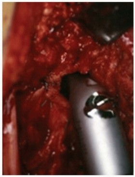 Illustration 22 for Allograft Prosthetic Composite: Mastering Proximal Femur Reconstruction