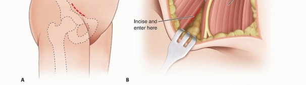 Illustration 11 for Septic Hip in Children: Mastering Anterior Drainage for Optimal Recovery