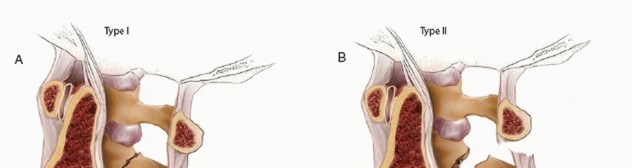 Illustration 15 for Master Techniques for Cervical Fracture Reduction: Type III & More