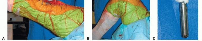 Illustration 24 for Correcting Stiffness in Revision TKA: Achieve Appropriate External Rotation