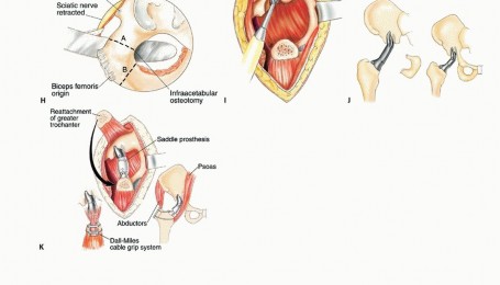 Illustration 32 for Surgical Pelvic Resection: Gluteus Maximus Muscle & Nerve Preservation