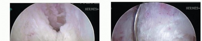 Illustration 14 for Posterior Cruciate Ligament Surgery: Regain Knee Strength & Stability