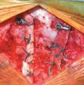 Illustration 21 for Cervical Fusion: The Line is Drawn for Lasting Stability