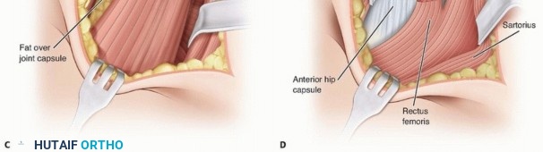 Illustration 13 for Septic Hip in Children: Mastering Anterior Drainage for Optimal Recovery