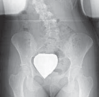 Illustration 2 for Mastering Anterior Interbody Arthrodesis with Instrumentation for Scoliosis