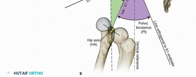 Illustration 10 for Mastering High-Grade Spondylolisthesis: Posterolateral and Interbody Fusion
