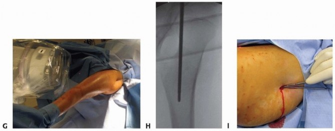 Illustration 12 for Pediatric Femoral Nailing: Targeting the Right aspect of the greater Trochanter