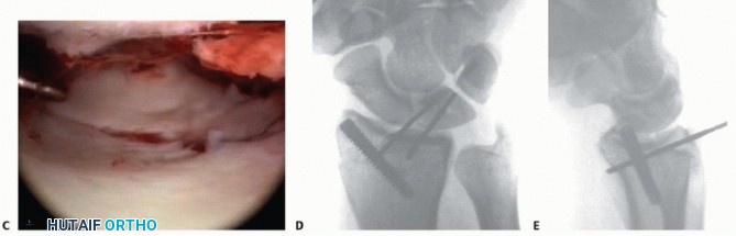 Illustration 7 for Arthroscopic Fixation: Effectively Treating Radial Styloid Fragments