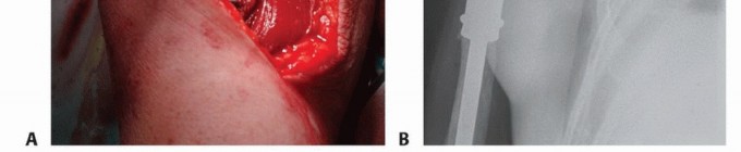 Illustration 25 for Restore Vital Function: Surgery for Type II Humeral Metastasis