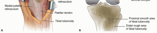 Illustration 2 for Tibial Tubercle Osteotomy: The Key to Extensile Exposure in Revision TKA