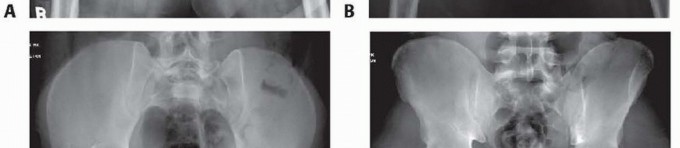 Illustration 4 for Achieve Stable Fixation of the Symphysis: Open Reduction
