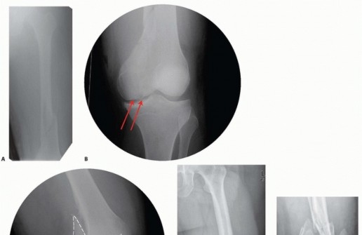 Illustration 10 for Repairing Distal Femur Fractures: Open Reduction & Internal Fixation