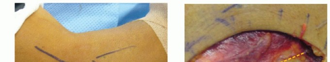 Illustration 27 for Radial Head & Neck Fractures: Mastering ORIF for Best Results