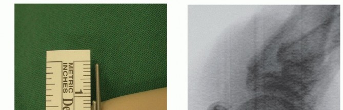 Illustration 14 for Optimizing Internal Fixation of Sesamoid Fractures