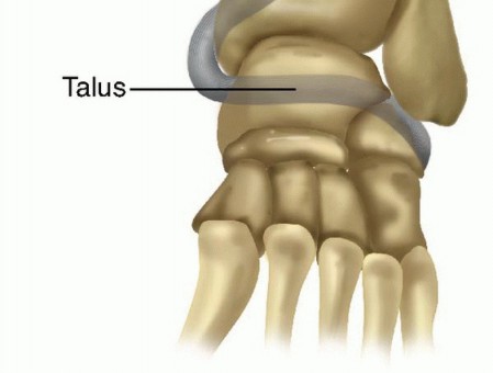 What to Expect from Invasive Deltoid Ligament Reconstruction