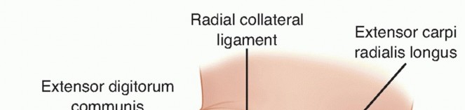 Illustration 7 for Radial Head Arthroplasty: Restoring Elbow Function & Stability