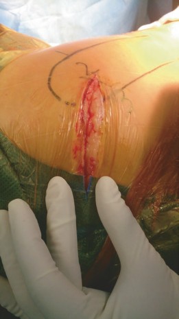 Illustration 3 for Mastering Direct Anterior Approach Hip Arthroplasty Without a Traction Table