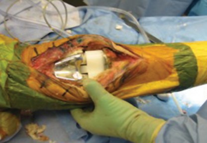 Illustration 31 for Uncemented Stems in Revision: A Guide to Success & Pitfalls