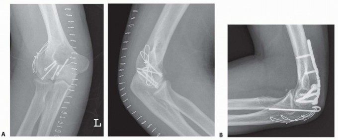 Illustration 14 for Navigating Capitellum and Capitellar-Trochlear Shear Fracture Repair