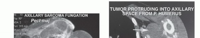 Illustration 7 for Axillary Space Exploration: Surgical Resection of Complex Tumors