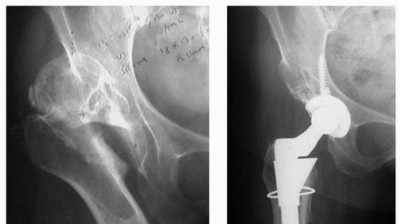 Illustration 15 for Overcoming Proximal Femoral Deformity in THA: Key Strategies