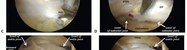 Illustration 19 for Posterior Talar Process: Endoscopic Solutions for Ankle Pain