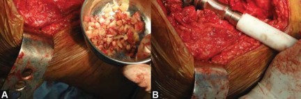 Illustration 34 for Optimizing Arthroplasty in Acute Fractures: Octopus System