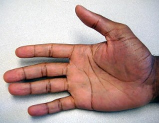 صورة طبية: دليل الأستاذ الدكتور محمد هطيف الشامل لأمراض وإصابات اليد والمعصم في صنعاء