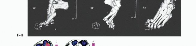 Illustration 5 for How Achilles Tendon Lengthening Fixes Equinocavovarus Foot